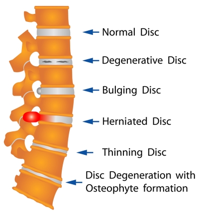 disc - disease